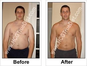 &quot;Hcg 500 Calorie Diet Side Effects